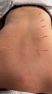 Nizan Pery – Acupuncturist